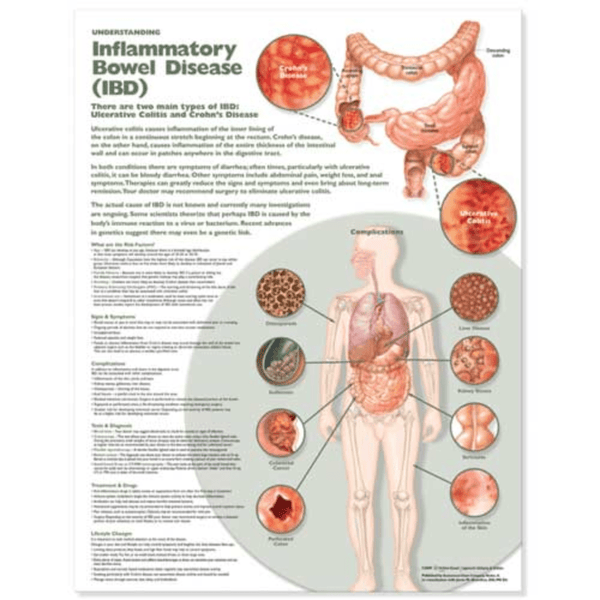 Anatomical Chart Company Anatomical Charts Understanding Inflammatory Bowel Disease (IBD) Anatomical Chart