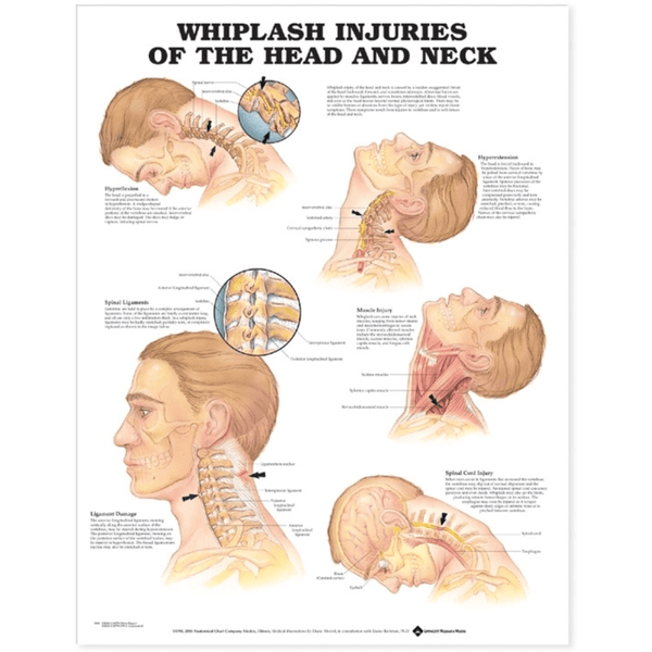 Anatomical Chart Company Anatomical Charts Whiplash Injuries of the Head and Neck Anatomical Chart