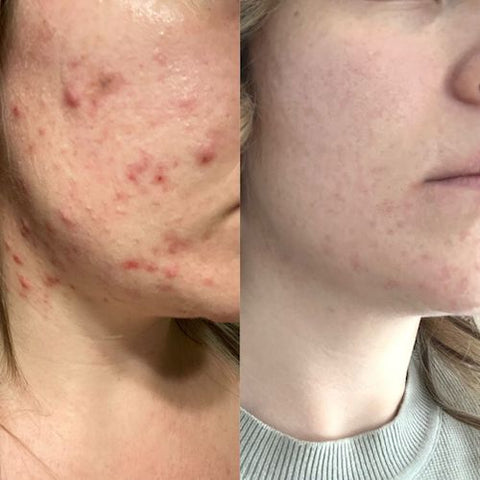 before and after acne treatment BBL forever clear langley bc 
