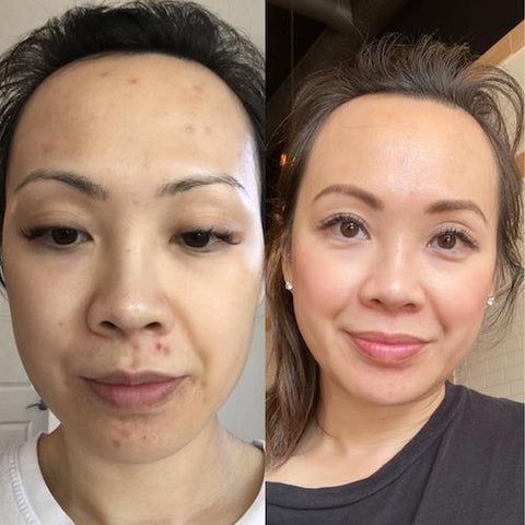 before and after laser genesis langley bc 