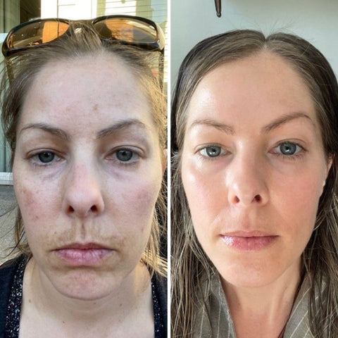 before and after melasma langley bc 