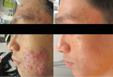 Chemical peel before and after acne - fort langley bc