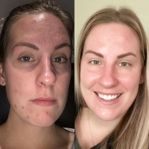 before and after laser genesis for acne in langley bc 