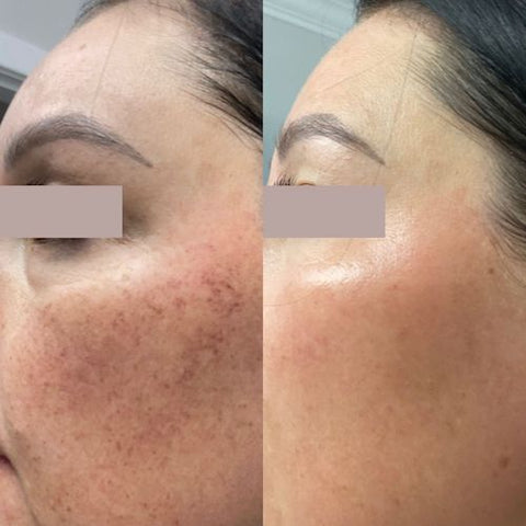 before and after photo facial langley bc 