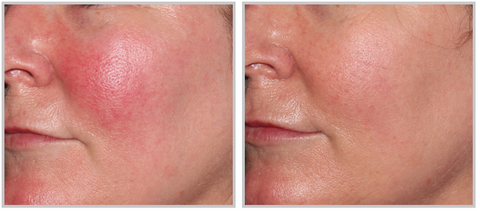 before and after forever young BBL for rosacea in fort langley 