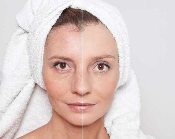 How Does RF Radio Frequency Skin Tightening Work? – SkinGenics ™ Online Shop