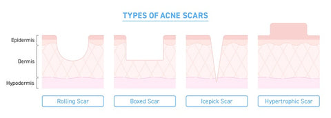 Types of acne scars