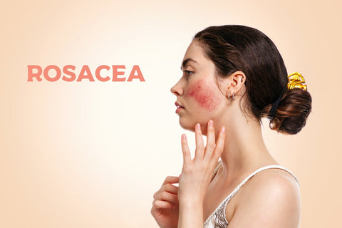 Rosacea