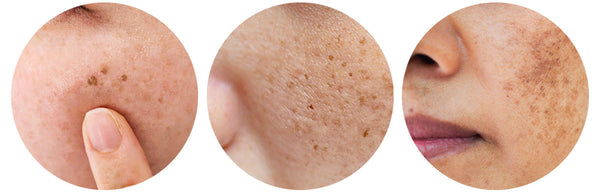 sun spots, hyperpigmentation