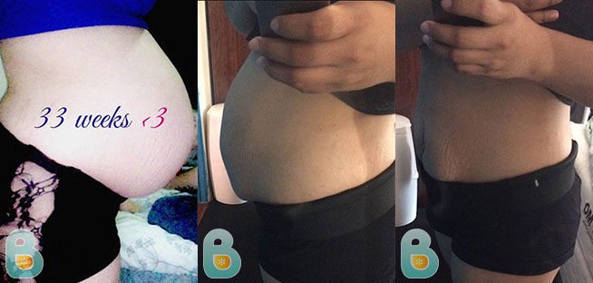 Sensitive Incision After C Section Bellefit Postpartum Girdle