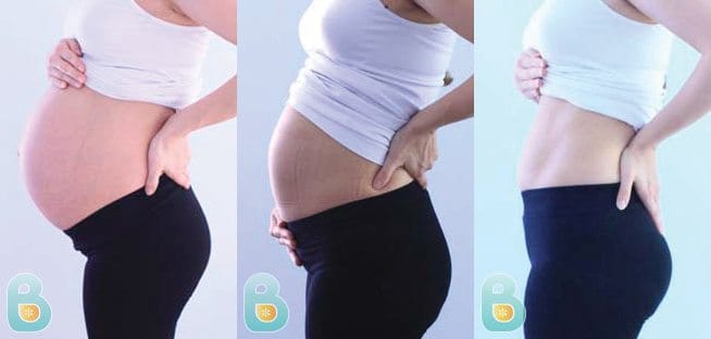 Postpartum Compression Garment Provides Abdominal Support