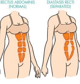 Abdominal Binders for Diastasis Recti