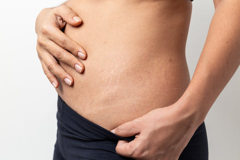 What are stretch marks and what can you do to get rid of them?