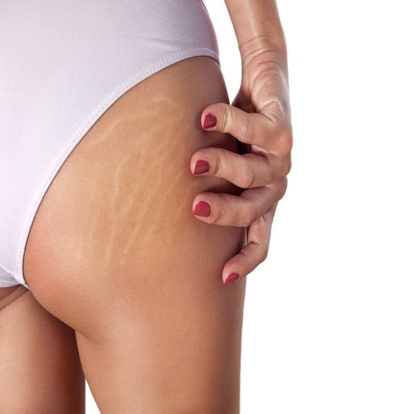 stretch mark removal cream