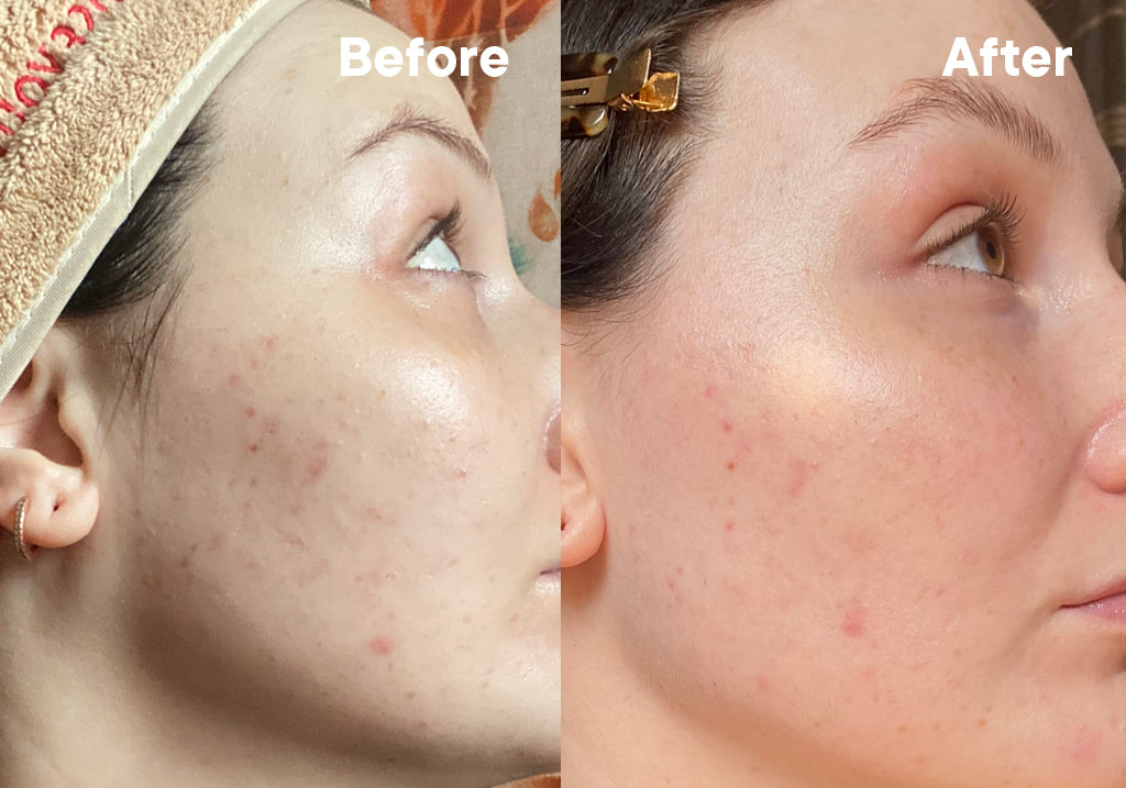 Before/After using Much Brighter Skin for three weeks.