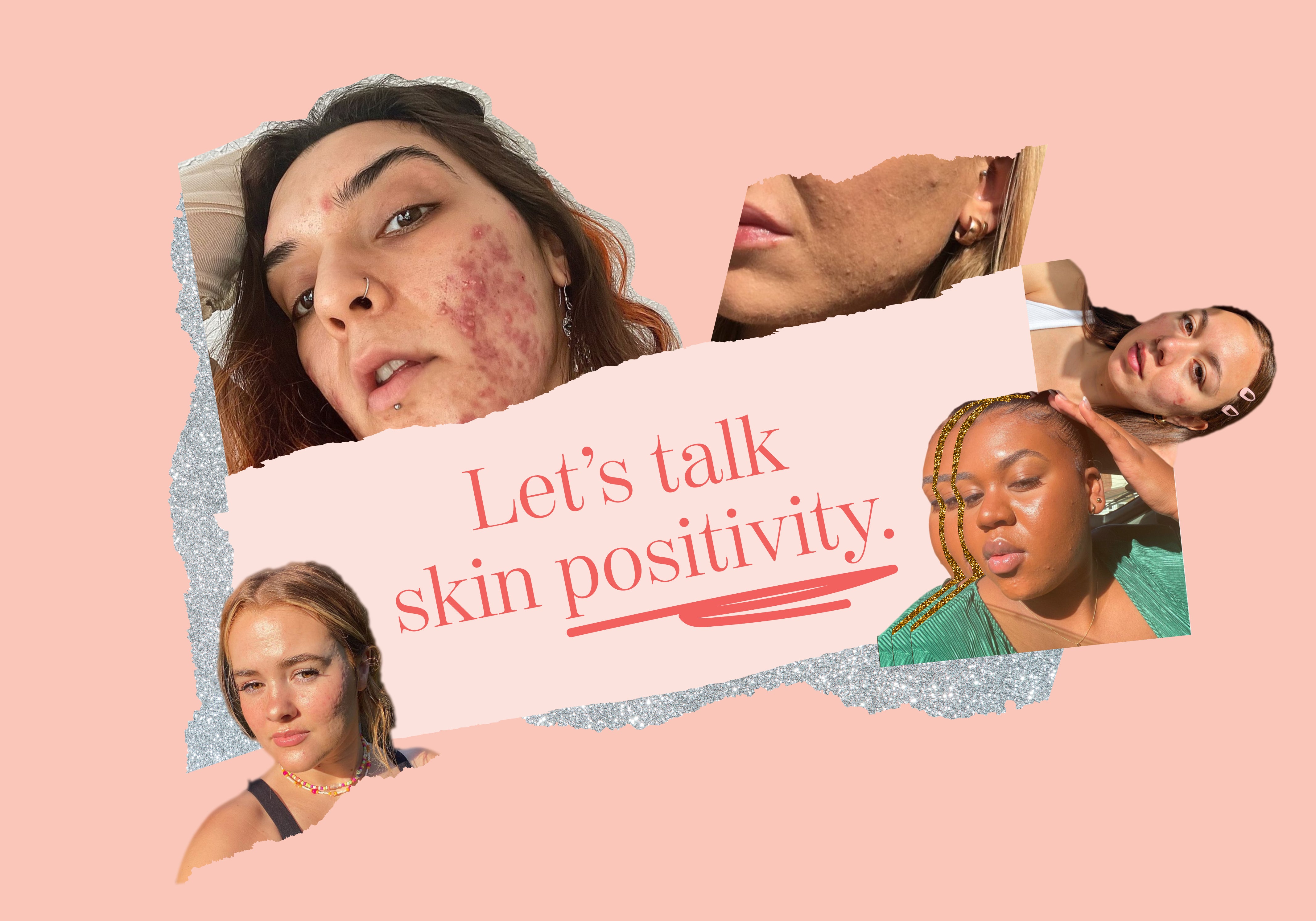 Let's Talk Skin Positivity: With Acne-Pos Influencers