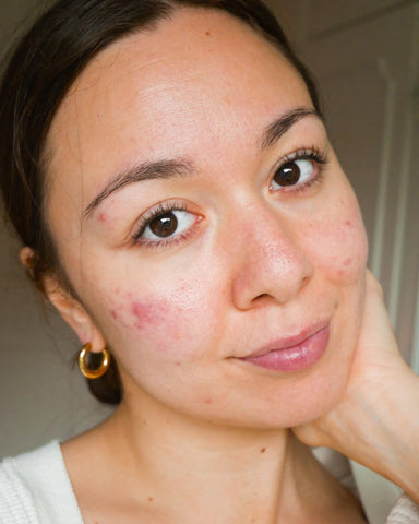 Evenlyn of skin-positive Instagram account, @normalise.acne