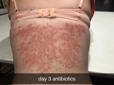 Psoriasis_day_3_antibiotics.jpg?v=158866