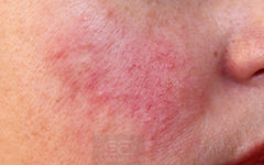 best rosacea treatment grahams natural