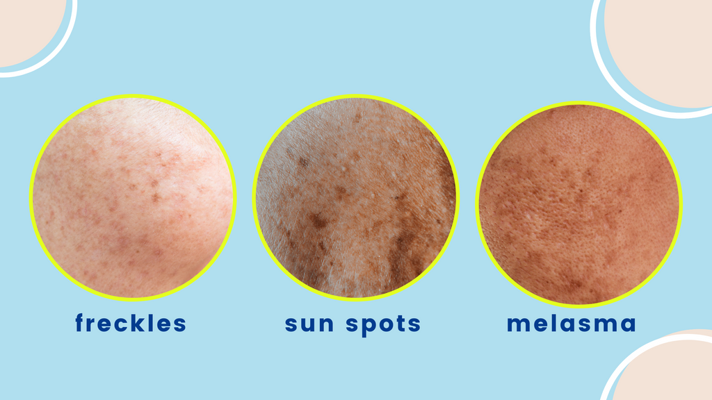 Freckles, Sun Spots or Melasma