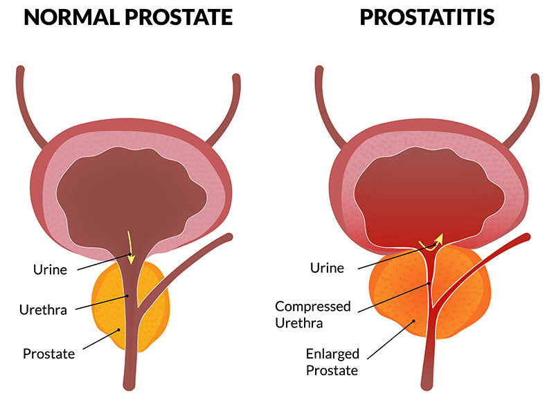 Prostatitis