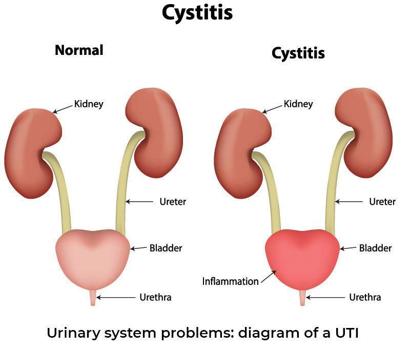 Urinary system problems: diagram of a UTI