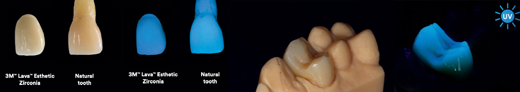 Lava Zirconia Implant Crown