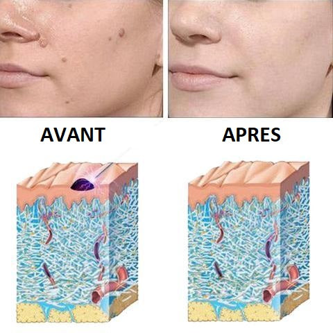 avant apres stylo laser