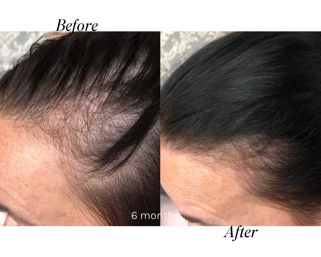 best hair loss treatment uk