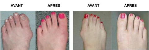 Chaussures Pour Hallux Valgus