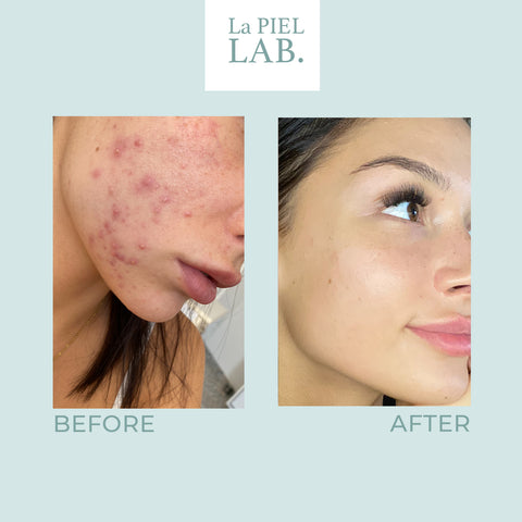 La PIEL Anja Blaa Before & After Bad Skin Chemical Peel