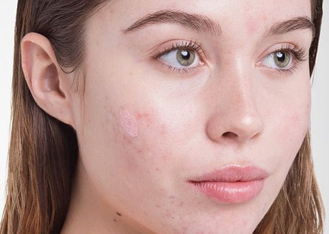 Retinol For Treating Acne Prone Skin