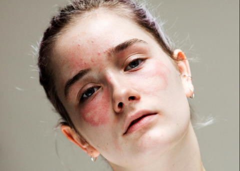 Antioxidants Help Skin Conditions Acne Rosacea