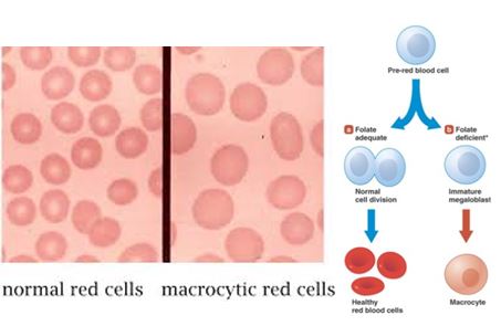 vitamin b9 deficiency