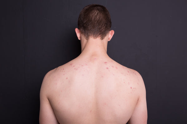 man with back acne