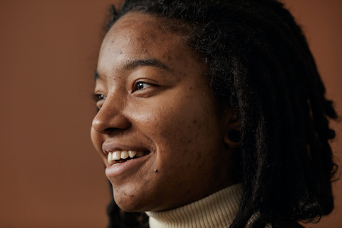 Woman with cleared acne