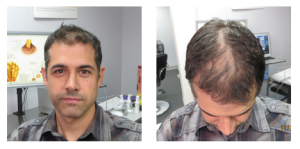 men hair regrowth results 1