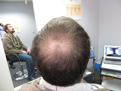 Men Hair Regrowth Results AB1