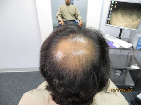 Men's Hair Regrowth Results AE1