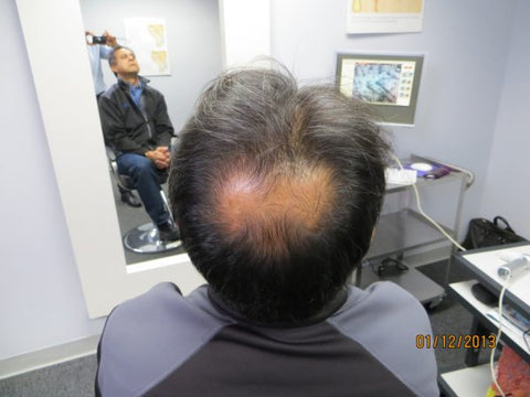 Men's Hair Regrowth Results AE2