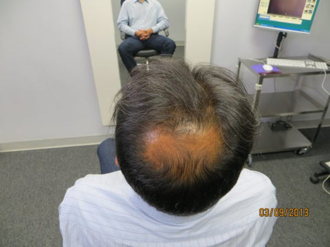 Men's Hair Regrowth Results AE3