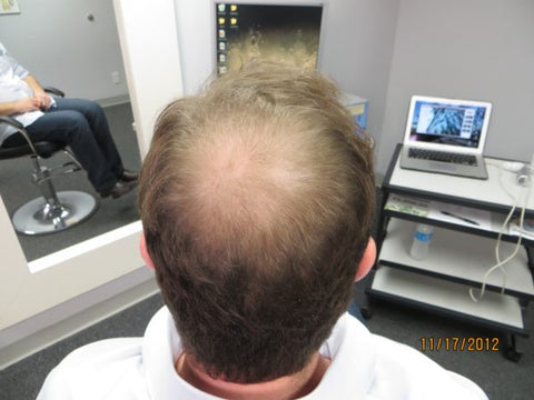 Men Hair Regrowth Results DB1