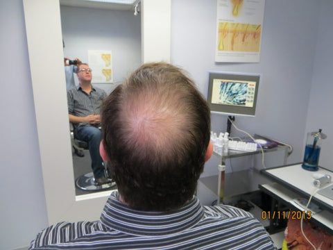 Men Hair Regrowth Results DB2
