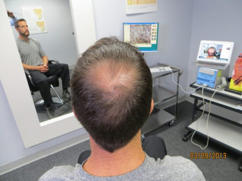 Men's Hair Regrowth Results DF3