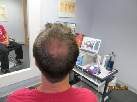 Men's Hair Regrowth Results DF4