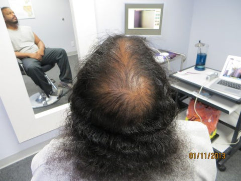 Men Hair Regrowth Results 7