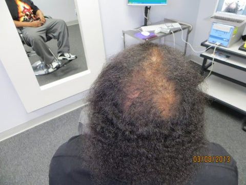 Men Hair Regrowth Results 8