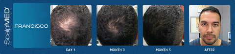 men's hair regrowth results 