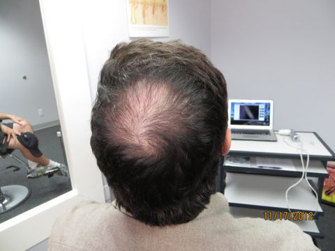 Men's Hair Regrowth Results FM1