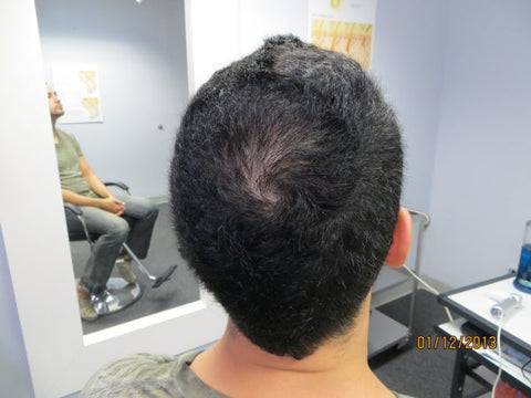 Men's Hair Regrowth Results FM2